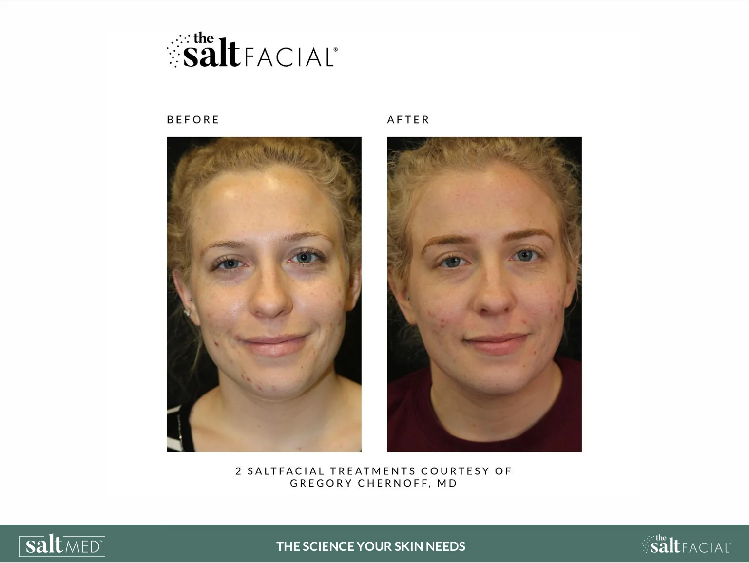 Salt Facial Before & After 2